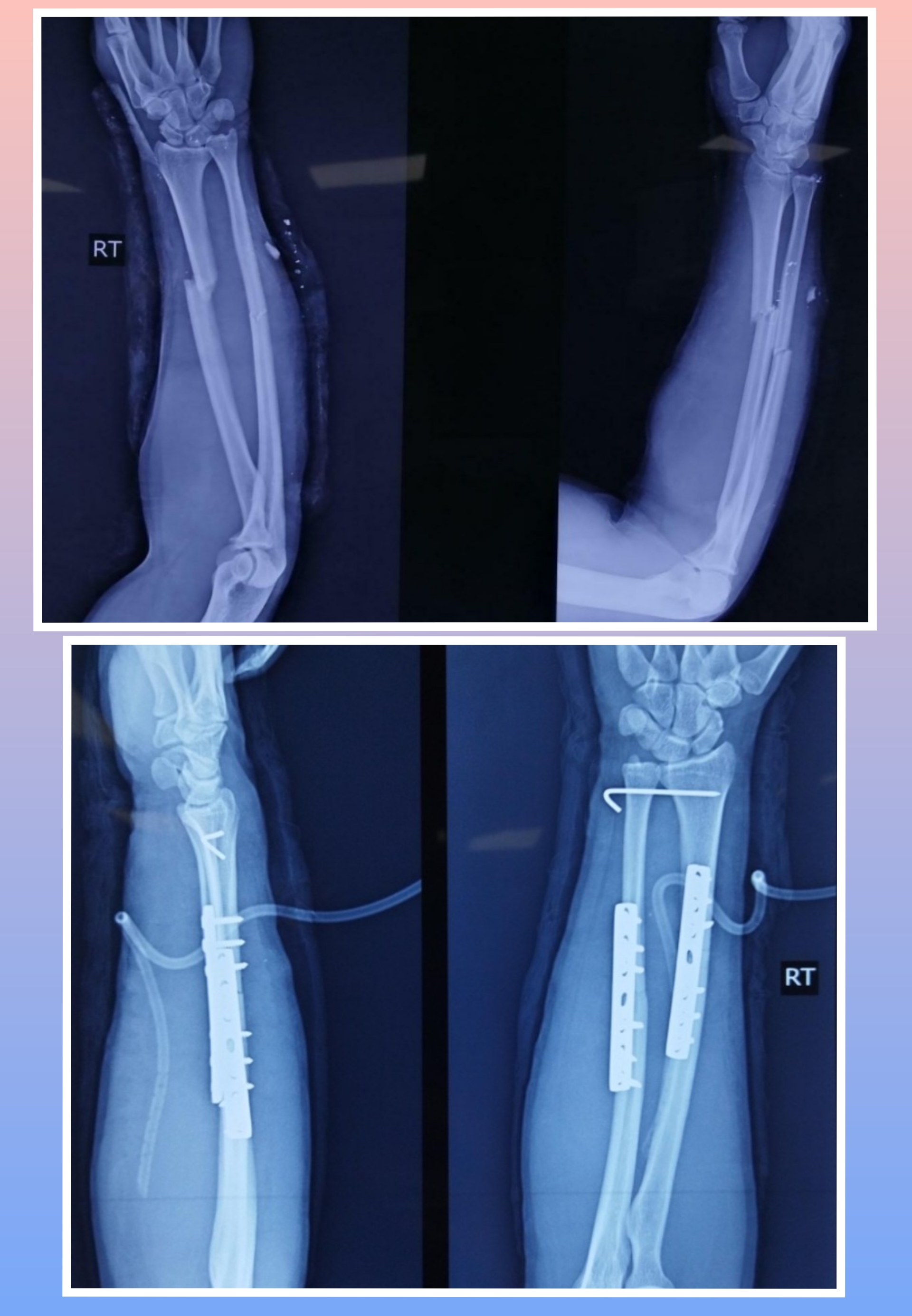Xray Image